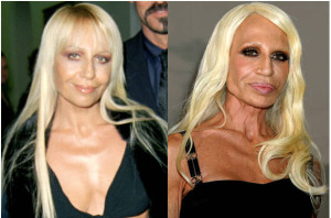 Donatella-Versace-Plastic-Surgery-before-and-after