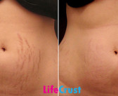 How To Get Rid Of Stretch Marks – DIYs!