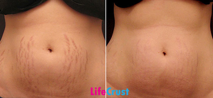 How To Get Rid Of Stretch Marks – DIYs!