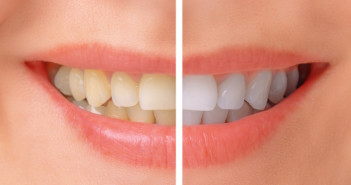 Teeth Whitening DIY