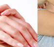 featured-dry-hands-n-elbows