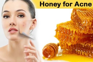 Honey-for-Acne