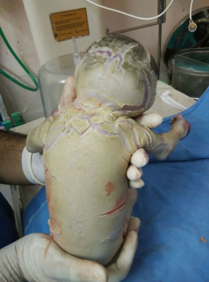 NAGPUR, INDIA - JUNE 12: A female infant affected by Harlequin ichthyosis, a severe genetic disorder, was born with almost no skin on her body on June 12, 2016 in Nagpur, India. Harlequin ichthyosis is a very rare severe genetic skin disease, which causes thickening of the stratum corneum of the epidermis. In such cases, the child's whole body is encased in an armour of thick white plates of skin, separated with deep cracks. PHOTOGRAPH BY Barcroft Images London-T:+44 207 033 1031 E:hello@barcroftmedia.com - New York-T:+1 212 796 2458 E:hello@barcroftusa.com - New Delhi-T:+91 11 4053 2429 E:hello@barcroftindia.com www.barcroftimages.com