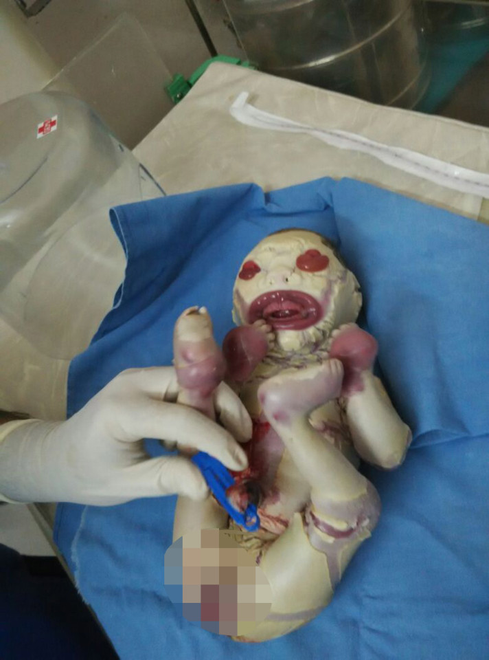 NAGPUR, INDIA - JUNE 12: A female infant affected by Harlequin ichthyosis, a severe genetic disorder, was born with almost no skin on her body on June 12, 2016 in Nagpur, India. Harlequin ichthyosis is a very rare severe genetic skin disease, which causes thickening of the stratum corneum of the epidermis. In such cases, the child's whole body is encased in an 'armour' of thick white plates of skin, separated with deep cracks. PHOTOGRAPH BY Barcroft Images London-T:+44 207 033 1031 E:hello@barcroftmedia.com - New York-T:+1 212 796 2458 E:hello@barcroftusa.com - New Delhi-T:+91 11 4053 2429 E:hello@barcroftindia.com www.barcroftimages.com