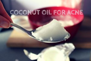 coconut-oil-for-acne