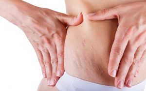 Home-Remedies-To-Get-Rid-Of-Stretch-Marks